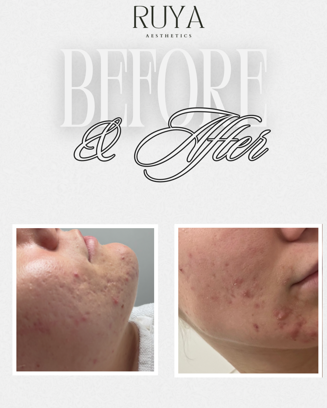 Prej in potem - nega obraza v Ruya Aesthetics